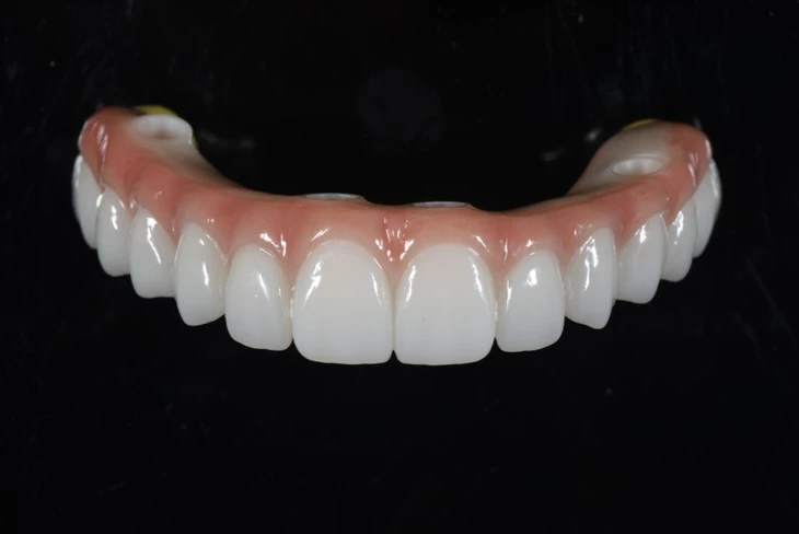-Pont Sħiħ tal-Arch Zirconia Bil-Qafas tat-Titanju