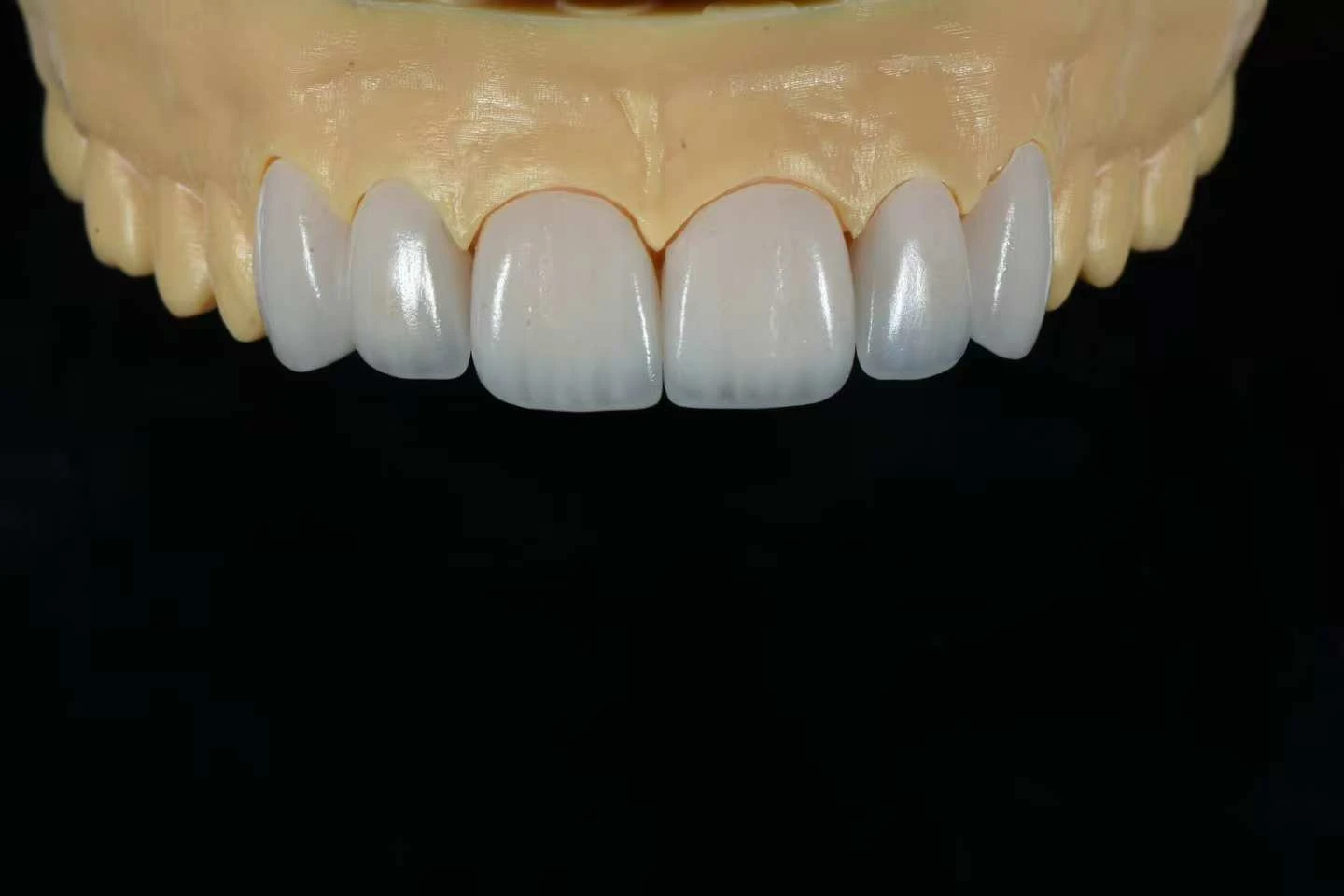 E.max Layering Veneers with Incisal Translucency E.max Layering Veneers with Incisal Translucency