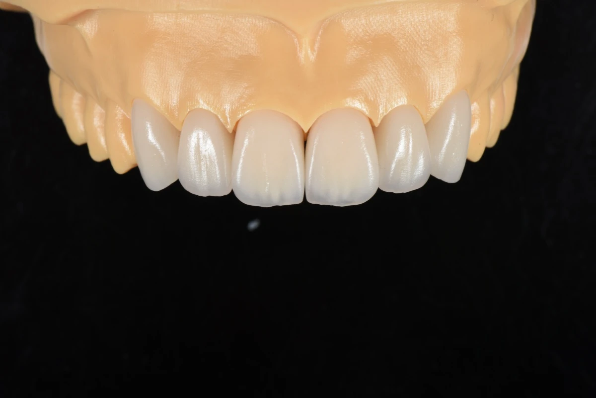 E.max Layering Veneers E.max Layering Veneers