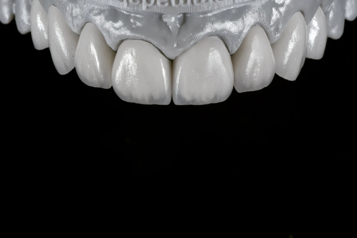 Hand-Layered E.max Veneers with Natural Facial Surface Morphology Hand-Layered E.max Veneers with Natural Facial Surface Morphology