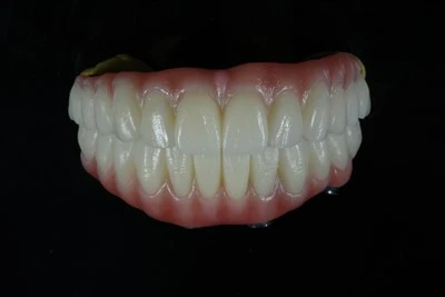 Kollha-fuq-X Zirconia Bridge With Pink Gingiva