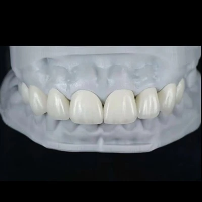 Fuljetti E.max Għall-Għeluq tad-Diastema