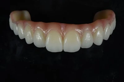 Sħiħ-Arch Zirconia Bridge b'Karatterizzazzjoni Ġinġivali