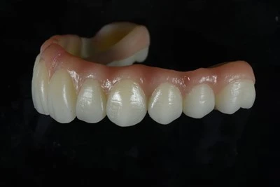 Implant-Sħiħ Appoġġjat-Arch Zirconia Bridge