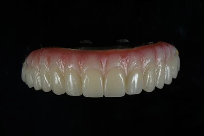 Maxillary All-fuq-X Zirconia Bridge