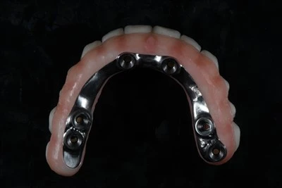 Invita-Miżmum Kollha-fuq-X Zirconia Bridge