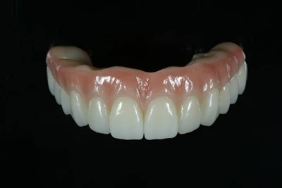 Titanju-Rinfurzat Kollha-fuq-X Zirconia Bridge